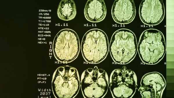 Scientists may have discovered first gene therapy for incurable brain disease Scientists may have discovered first gene therapy for incurable brain disease