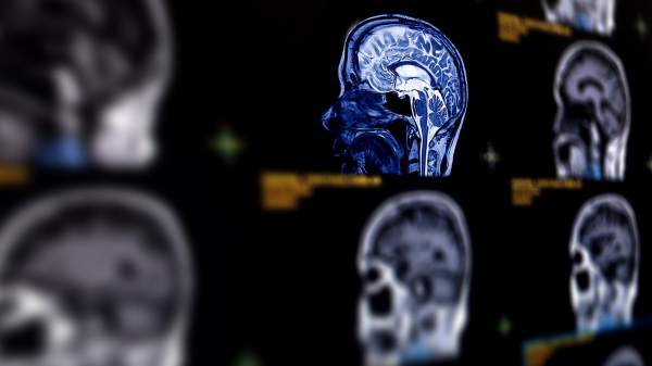 Kim Kardashian’s brain aneurysm scare: Doctors reveal warning signs to never ignore Kim Kardashian’s brain aneurysm scare: Doctors reveal warning signs to never ignore