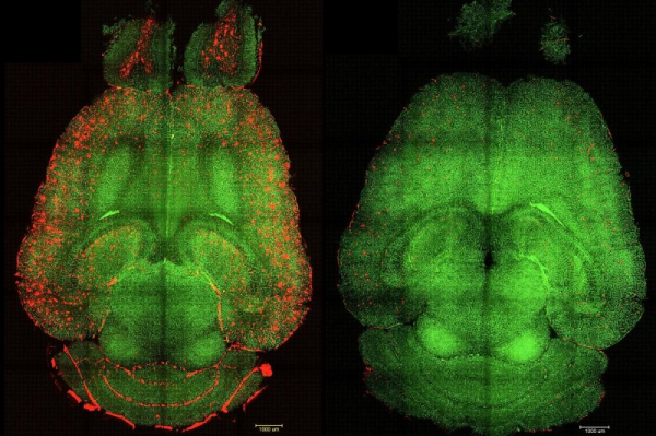 Scientists use nanoparticles to clear Alzheimer's brain plaque in mice Scientists use nanoparticles to clear Alzheimer's brain plaque in mice
