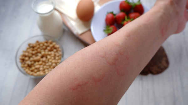 ‘Perfect storm’: Doctors warn of alarming rise in adult-onset food allergies ‘Perfect storm’: Doctors warn of alarming rise in adult-onset food allergies