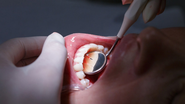 Treating gum disease could reduce risk of heart attacks and strokes, study suggests Treating gum disease could reduce risk of heart attacks and strokes, study suggests