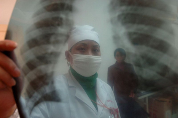 Lung cancer remains deadliest cancer, but patients are living longer Lung cancer remains deadliest cancer, but patients are living longer