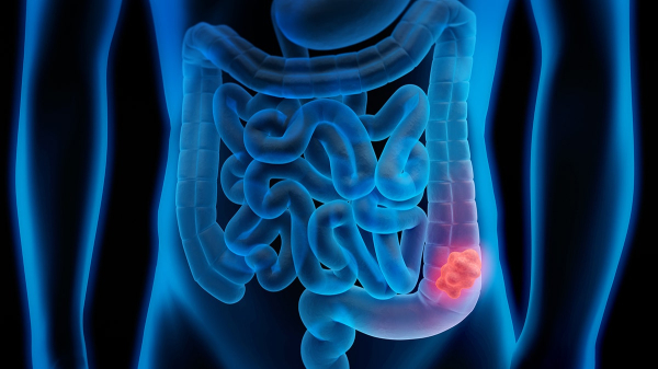 Hidden virus inside gut bacteria linked to doubled colorectal cancer risk, study finds Hidden virus inside gut bacteria linked to doubled colorectal cancer risk, study finds