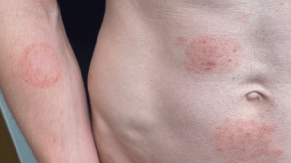 State confirms outbreak of sexually transmitted fungal infection, experts urge caution State confirms outbreak of sexually transmitted fungal infection, experts urge caution