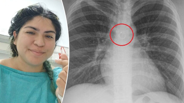 Woman discovers missing nose ring traveled to her lungs, causing month-long cough Woman discovers missing nose ring traveled to her lungs, causing month-long cough