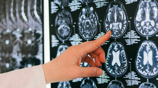 Experimental Alzheimer&rsquo;s drug could reduce alcohol withdrawal damage, researchers say