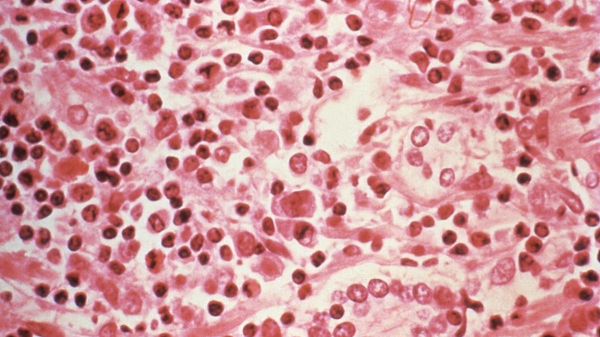 Hantavirus deaths on cruise ship highlight dangers of rodent-borne disease