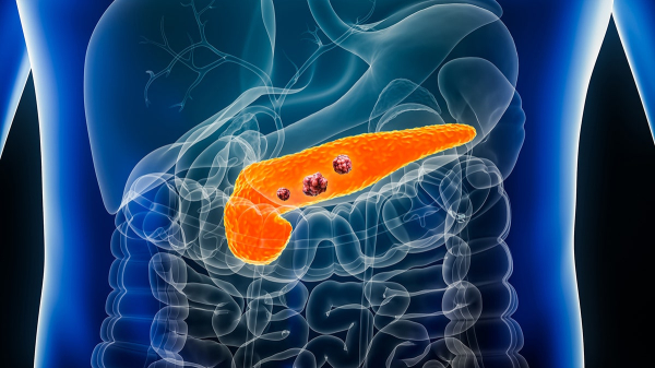 New pancreatic cancer pill could reshape treatment as early trial results stun researchers